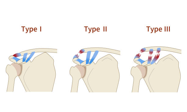 Stages of Frozen Shoulder